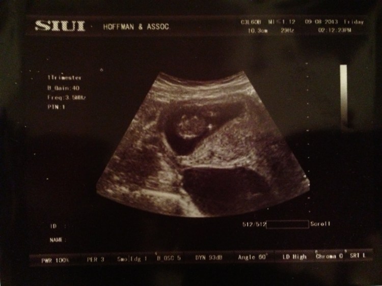 03_Sonogram_11Week