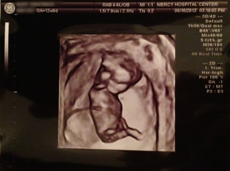 04_Sonogram_12Week-2