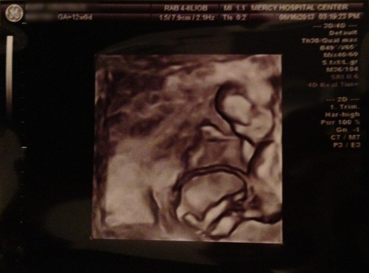 04_Sonogram_12Week-3