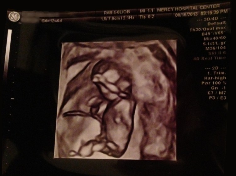 04_Sonogram_12Week-4